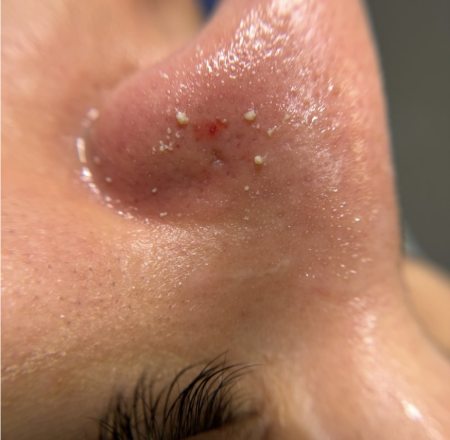 Before Nose Cleaning